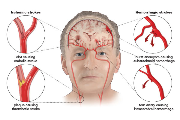 The hidden causes of stroke
